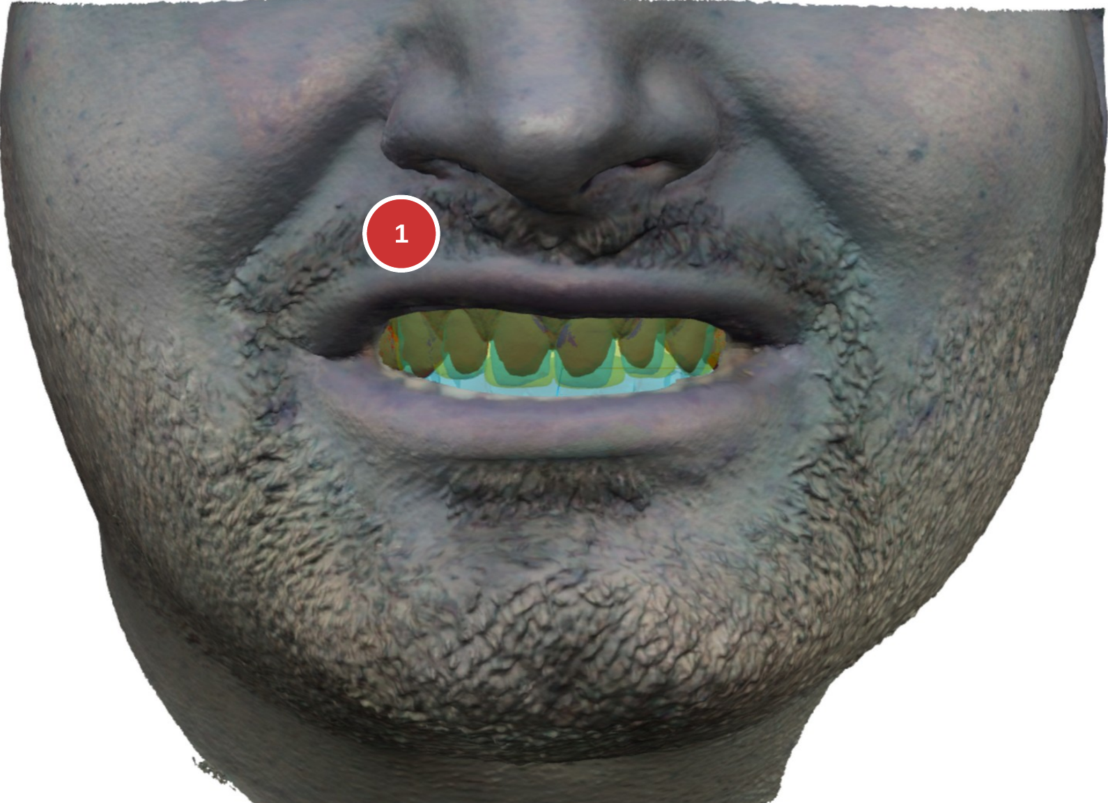 Fig. 8: Textured face scan with overlaid tooth models
